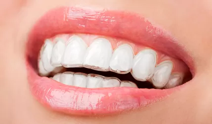 Чистка зубов с брекетами и элайнерами: в чем разница?
