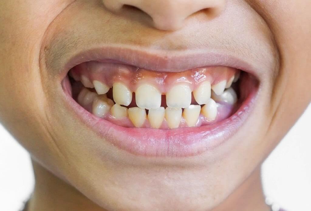 Промежутки между зубами. Как их убрать