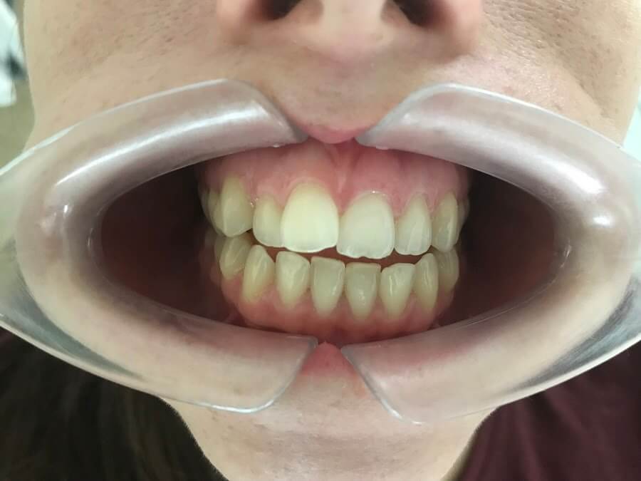 Открытый прикус: как он вредит зубам и как его исправить