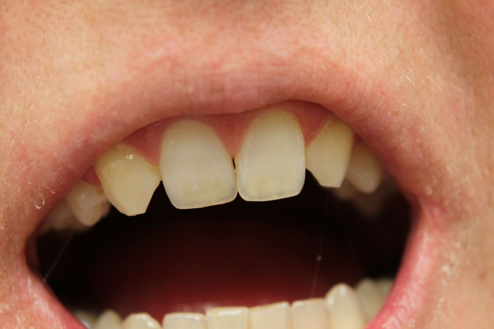 Исправление зубов при частичной адентии: как это устроено