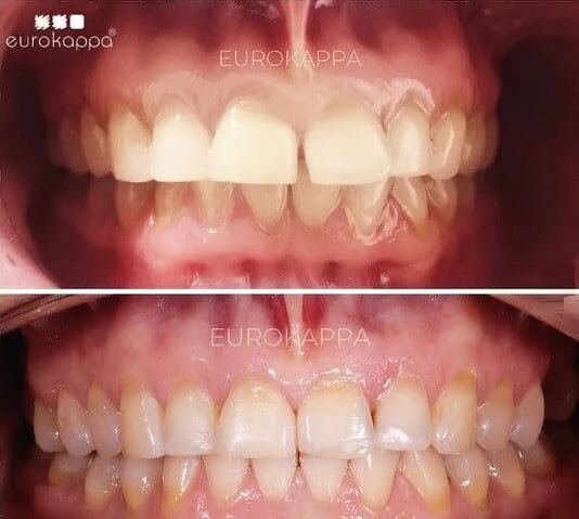 Стираемость зубов: показываем на примере нашего пациента, что это такое