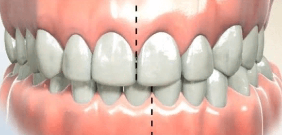 Не совпадает центральная линия зубов: как исправить?