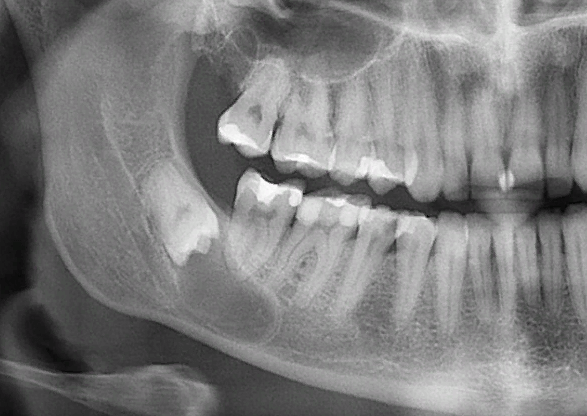 Как предотвратить резорбцию кости челюсти?